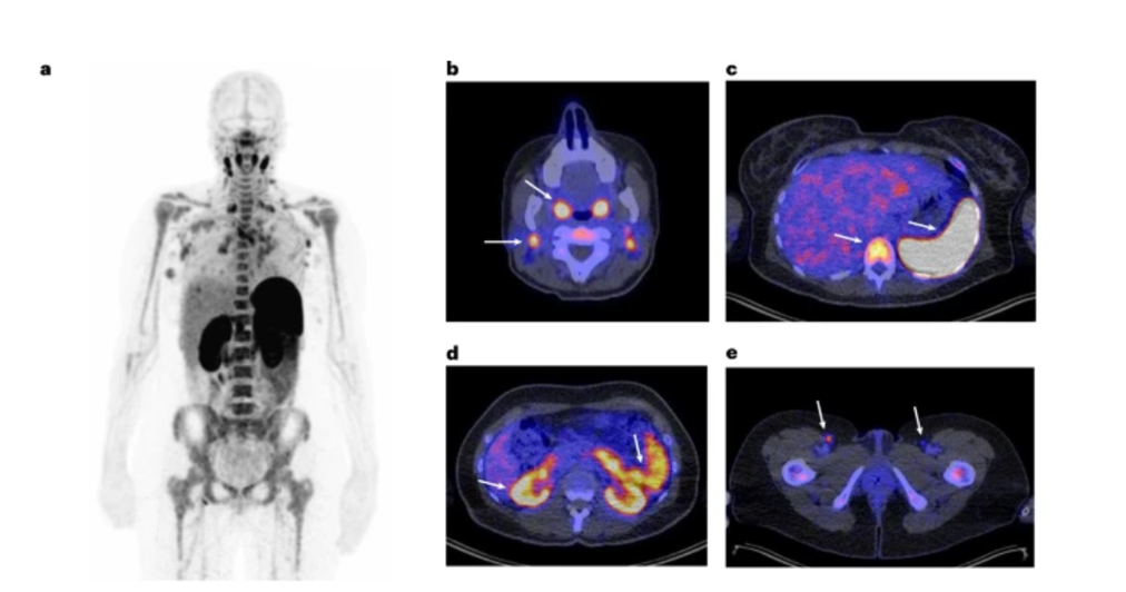 تصویر سازی از سلول های CD8+ T تمام بدن قبل و هنگام ایمونوتراپی سرطان: مطالعات بالینی فاز 1/2